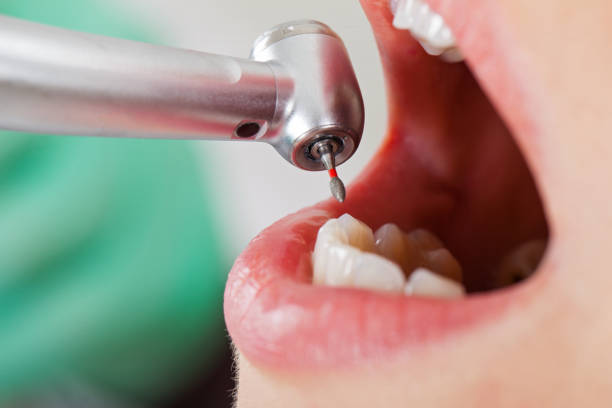 Best Emergency Tooth Extraction in Salida, CA
